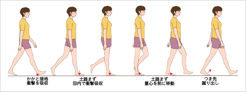 DSISインソールが内反小趾を改善