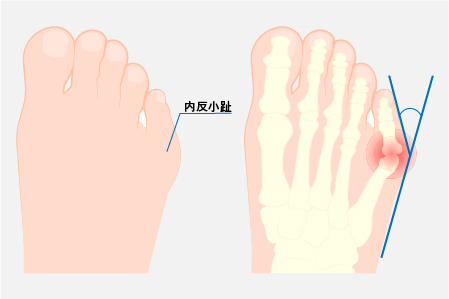 内反小趾の判定基準