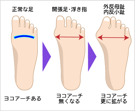 内反小趾サポーター 外反母趾内反小趾サポーター