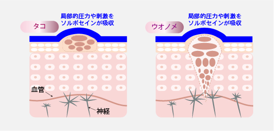 タコ･ウオノメにかかる衝撃をソルボセイン®が吸収