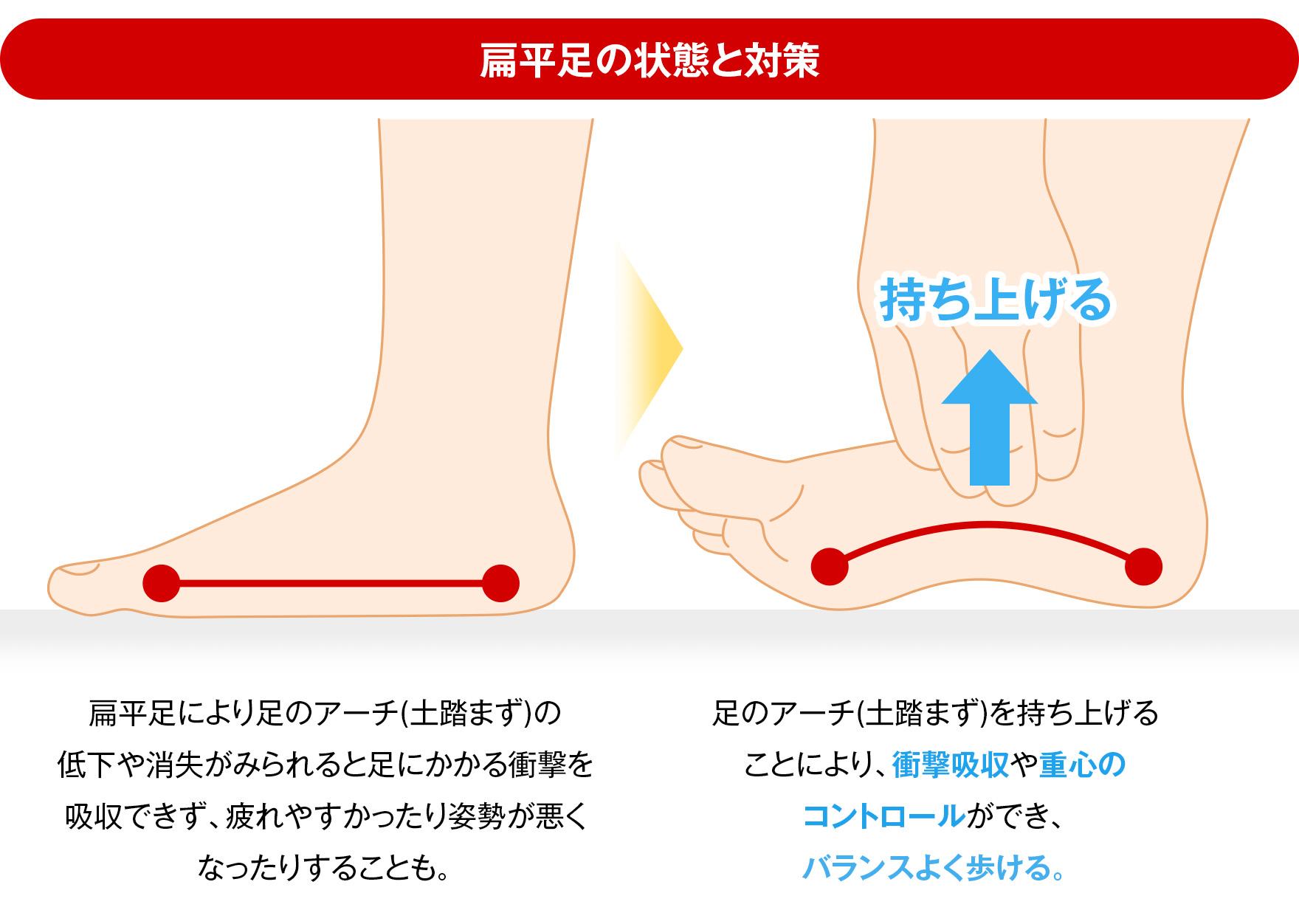 扁平足・ハイアーチだと何が良くないの?